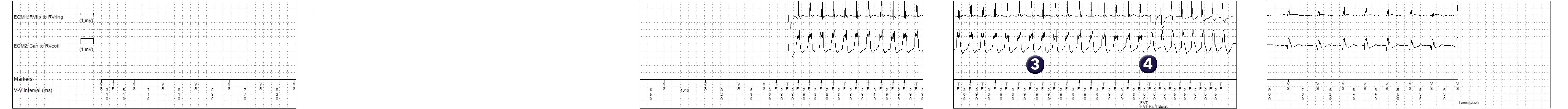 Medtronic ICD electrogram, segment 1 of 1 — Specific features of the fast VT counter