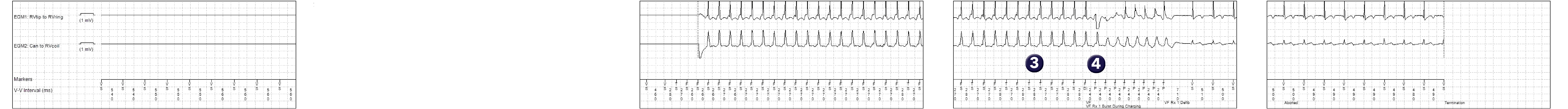 Medtronic ICD electrogram, segment 1 of 1 — Combined counter
