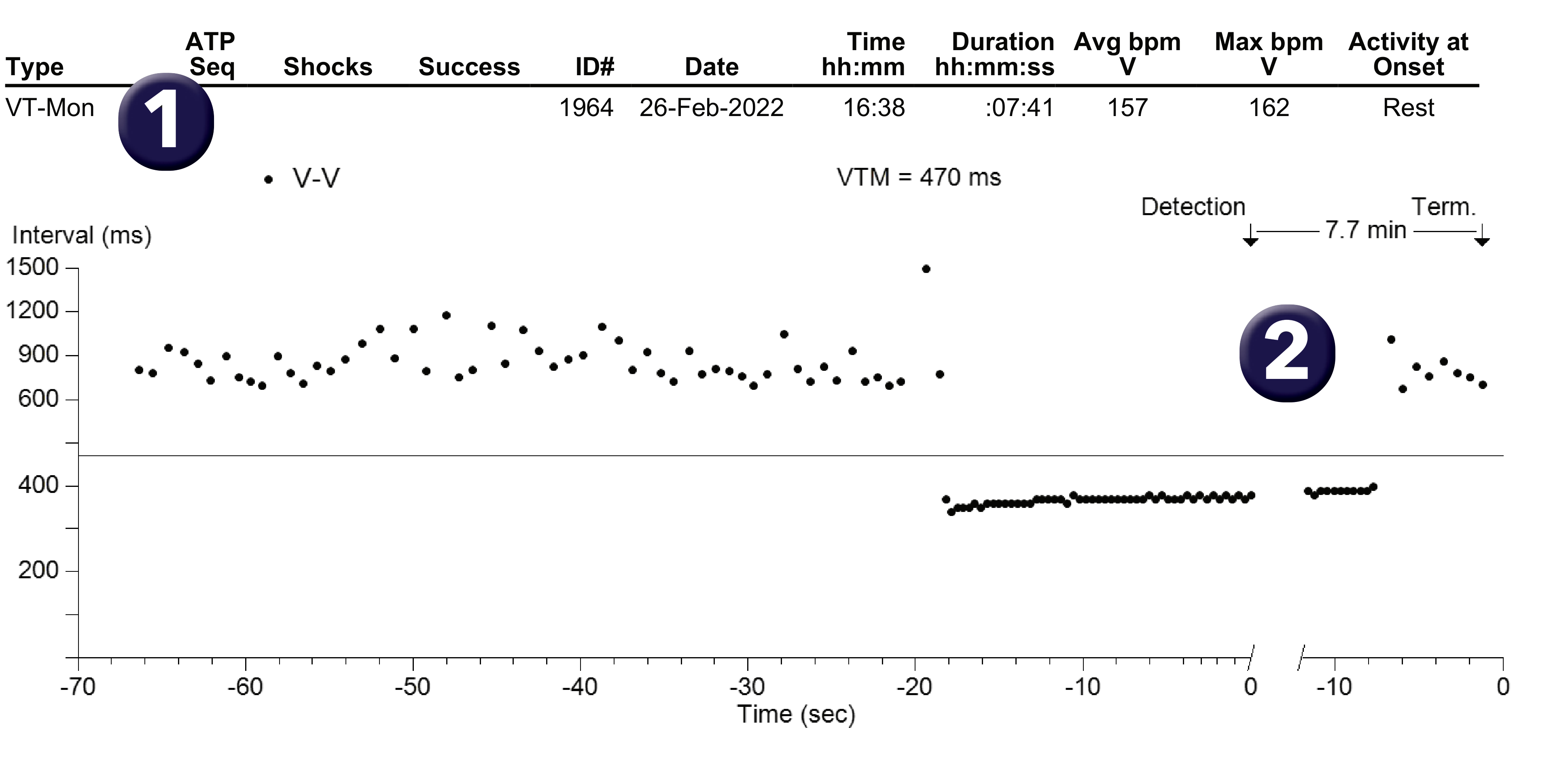 Medtronic ICD electrogram, segment 1 of 1 — VT and the monitor zone