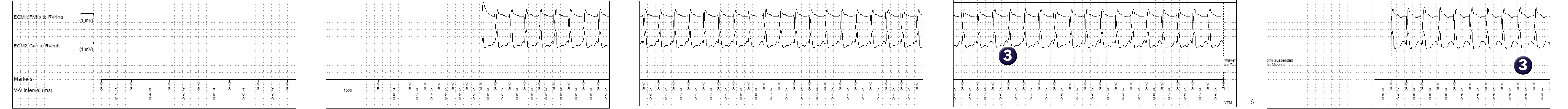 Medtronic ICD electrogram, segment 1 of 2 — VT and the monitor zone