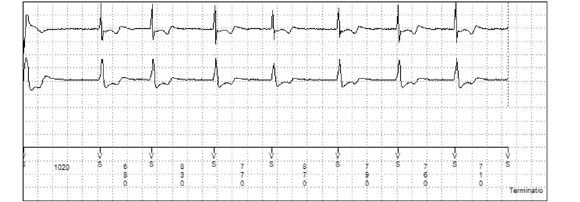 Medtronic ICD electrogram, segment 2 of 2 — VT and the monitor zone