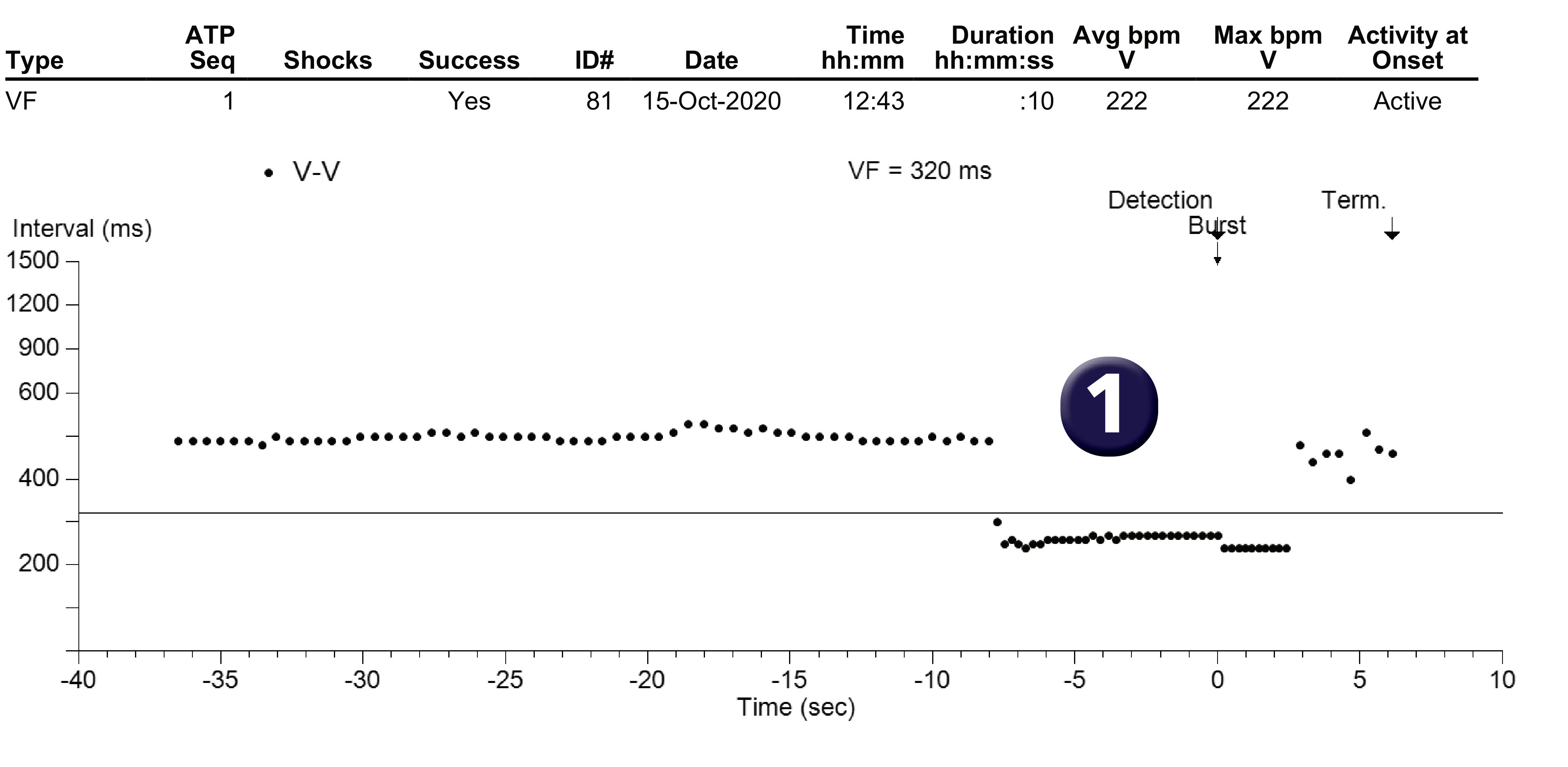 Medtronic ICD electrogram, segment 1 of 1 — A ventricular arrhythmia in the VF zone