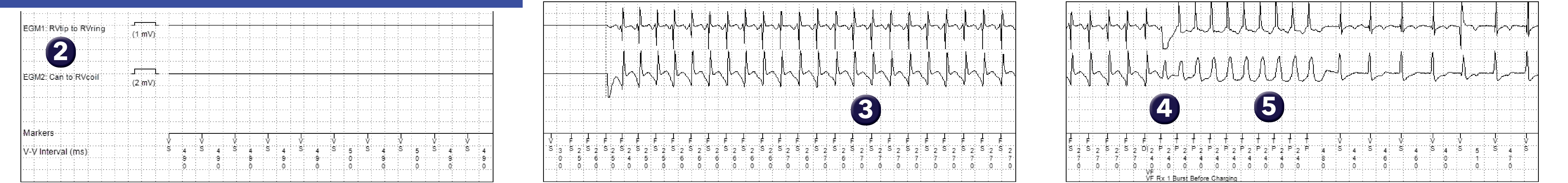 Medtronic ICD electrogram, segment 1 of 1 — A ventricular arrhythmia in the VF zone