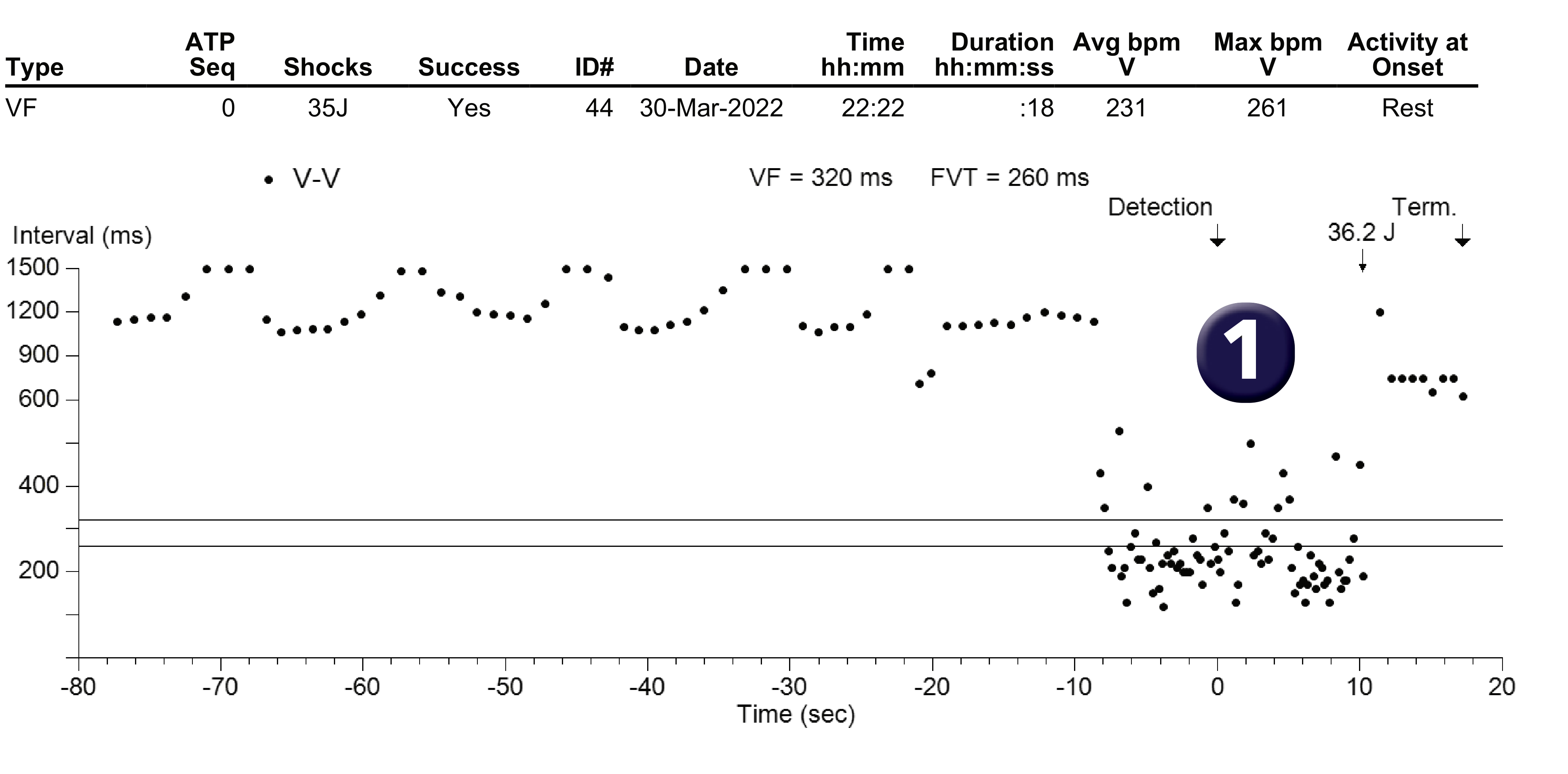 Medtronic ICD electrogram, segment 1 of 1 — Utility of a probabilistic counter in the VF zone