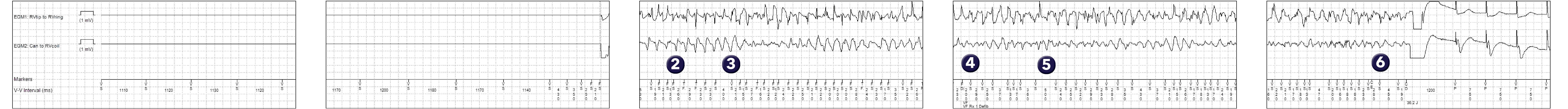 Medtronic ICD electrogram, segment 1 of 2 — Utility of a probabilistic counter in the VF zone