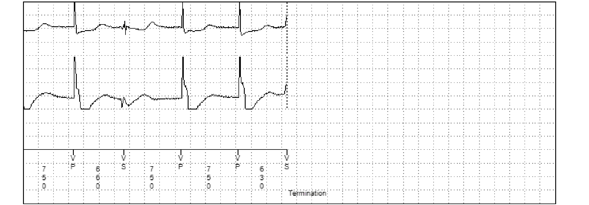 Medtronic ICD electrogram, segment 2 of 2 — Utility of a probabilistic counter in the VF zone