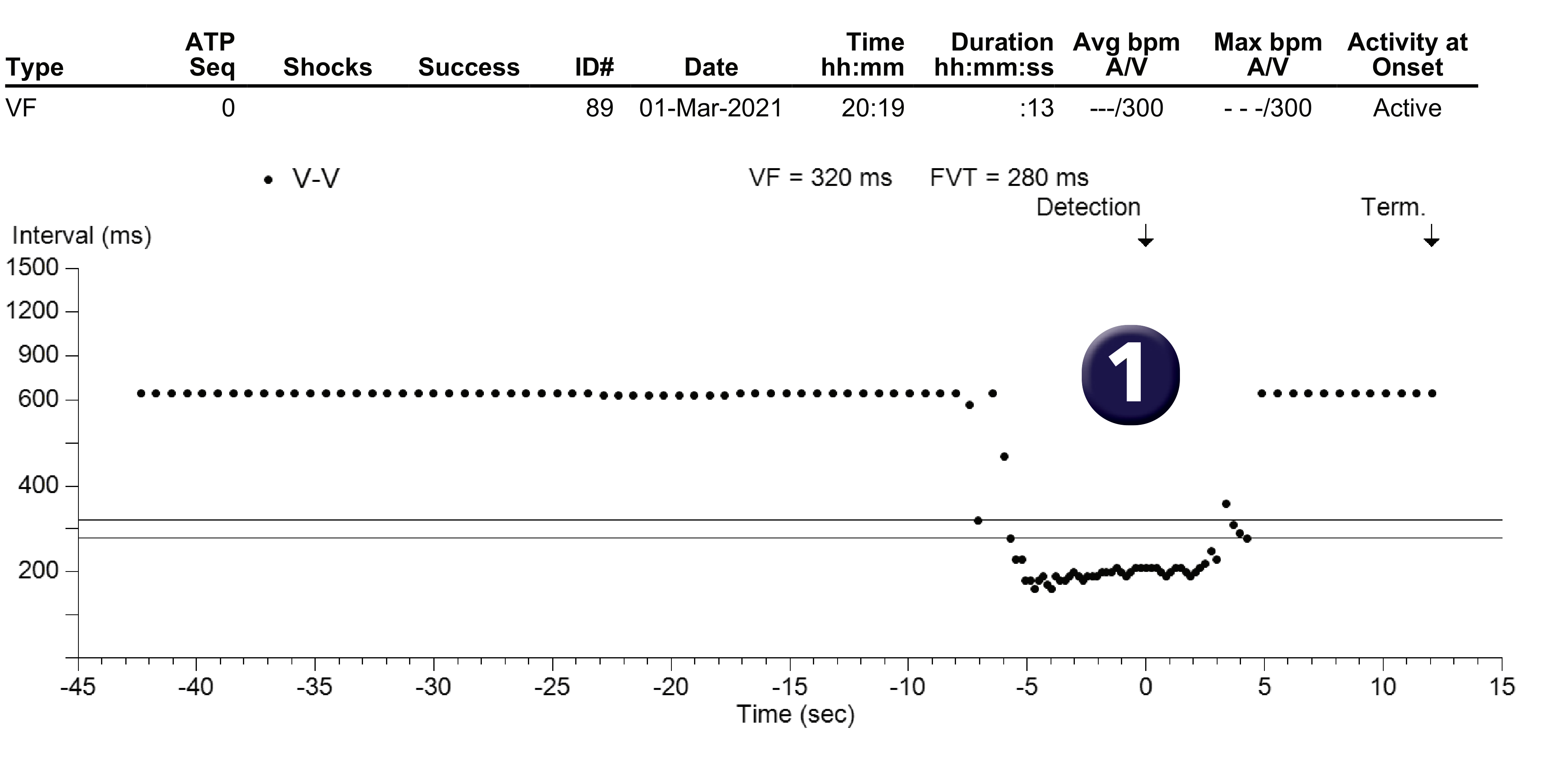 Medtronic ICD electrogram, segment 1 of 1 — Spontaneous termination of a ventricular arrhythmia