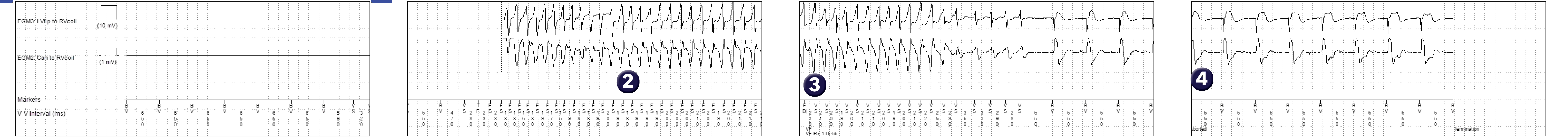 Medtronic ICD electrogram, segment 1 of 1 — Spontaneous termination of a ventricular arrhythmia