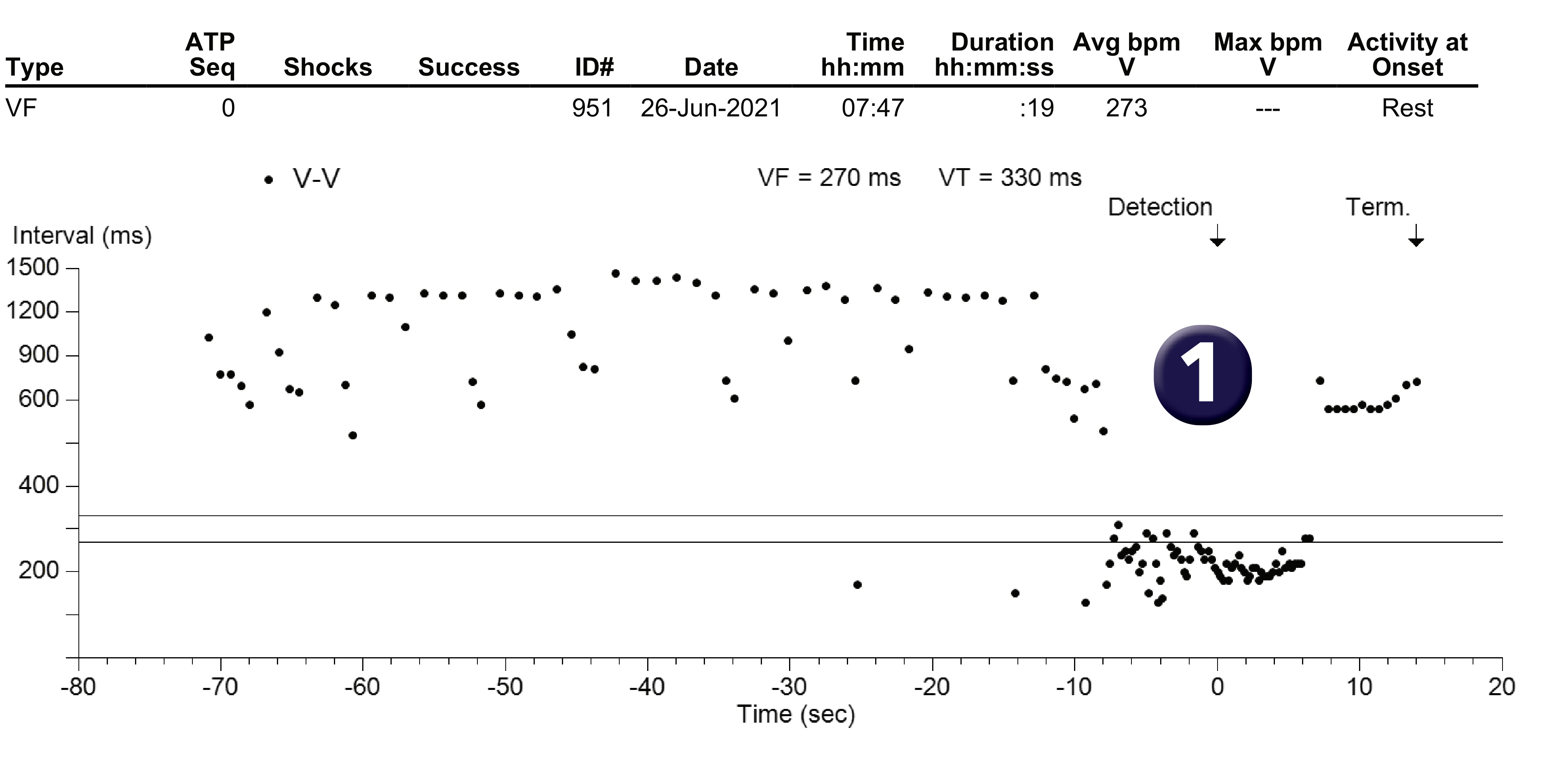 Medtronic ICD electrogram, segment 1 of 1 — Increasing counters and preventing avoidable therapies