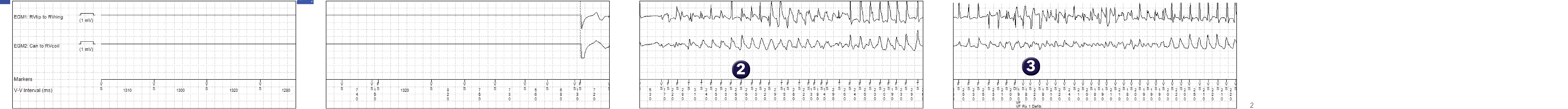 Medtronic ICD electrogram, segment 1 of 2 — Increasing counters and preventing avoidable therapies