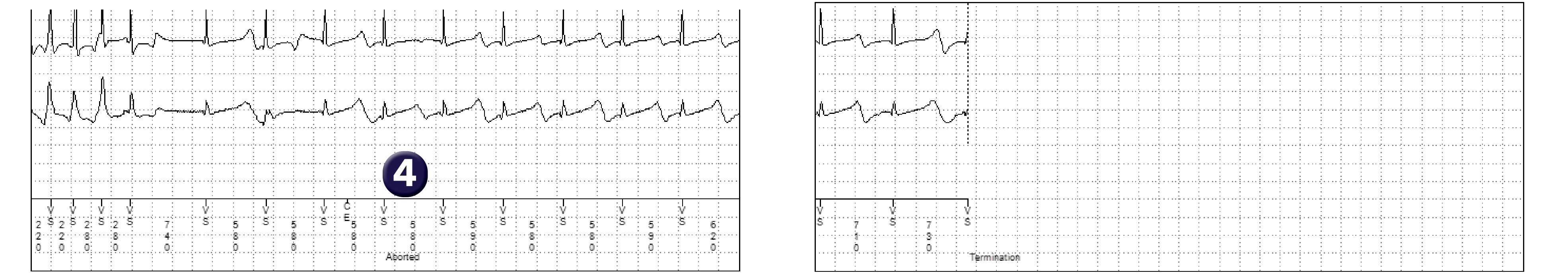 Medtronic ICD electrogram, segment 2 of 2 — Increasing counters and preventing avoidable therapies