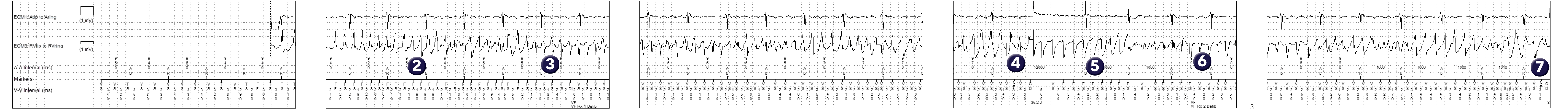 Medtronic ICD electrogram, segment 1 of 2 — Initial counter and redetection counter