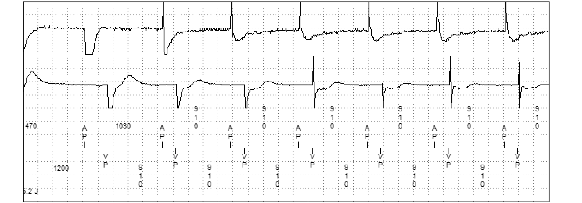 Medtronic ICD electrogram, segment 2 of 2 — Initial counter and redetection counter
