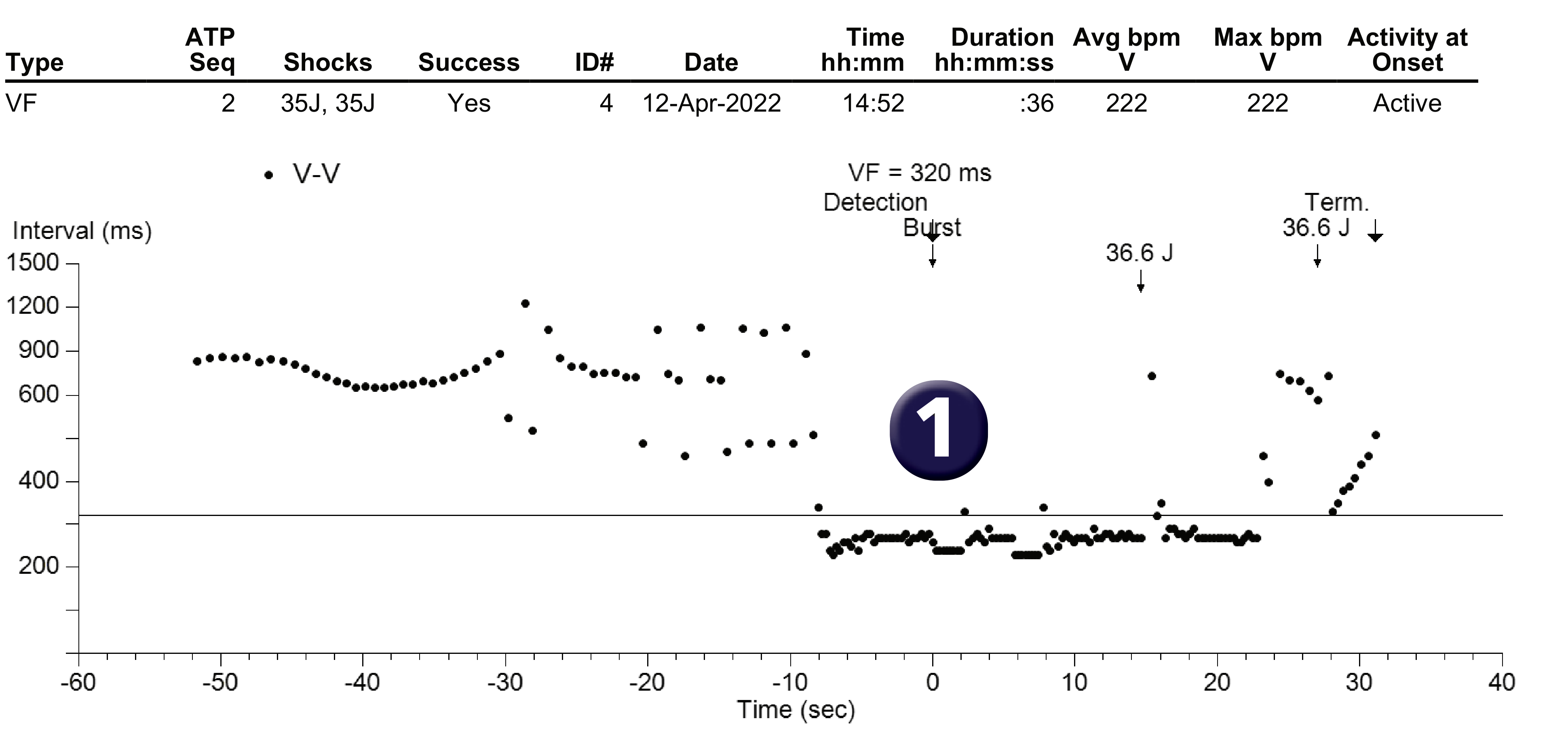 Medtronic ICD electrogram, segment 1 of 1 — No confirmation for a second shock