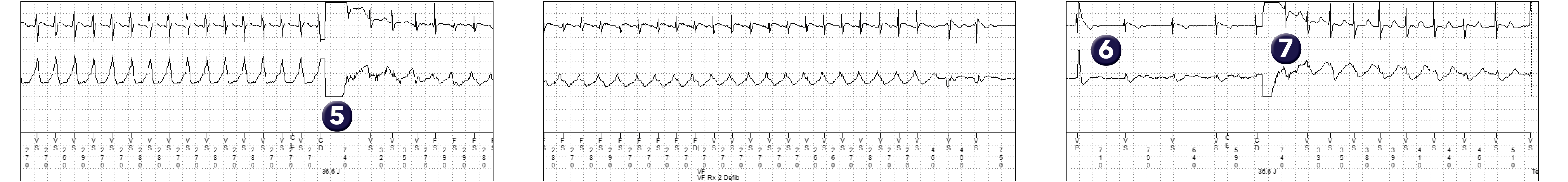 Medtronic ICD electrogram, segment 2 of 2 — No confirmation for a second shock