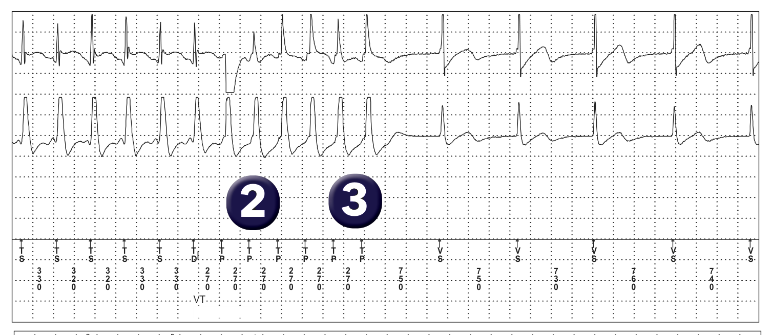 Medtronic ICD electrogram, segment 1 of 1 — Specifics of the VT counter