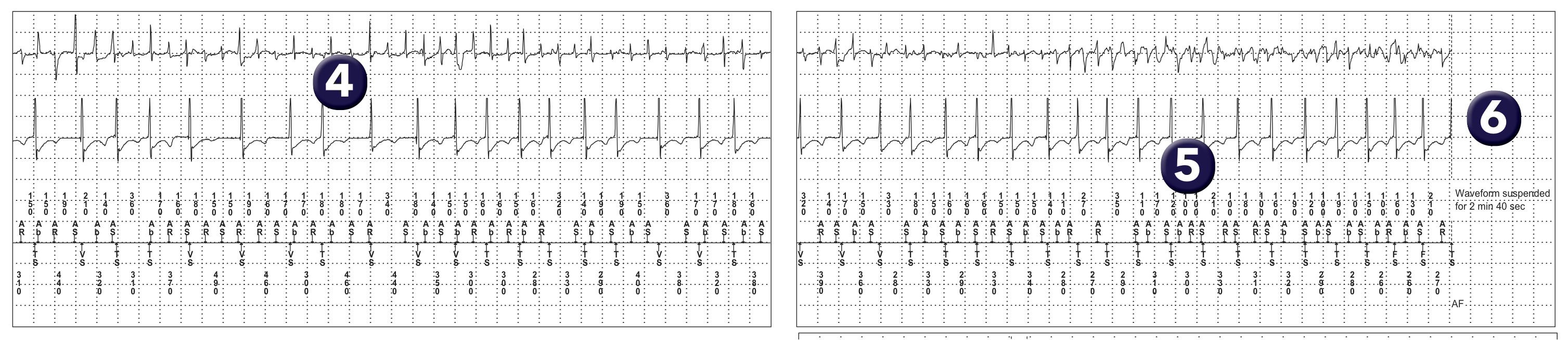 Medtronic ICD electrogram, segment 1 of 1 — AF and the VT counter