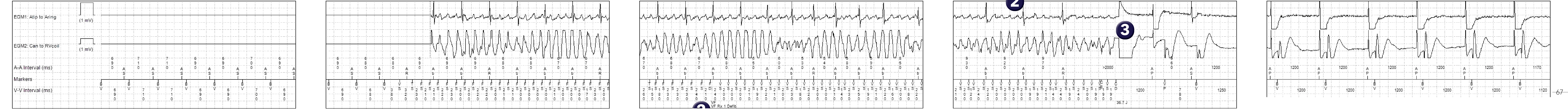 Medtronic ICD electrogram, segment 1 of 1 — A shock to restore a viable rhythm