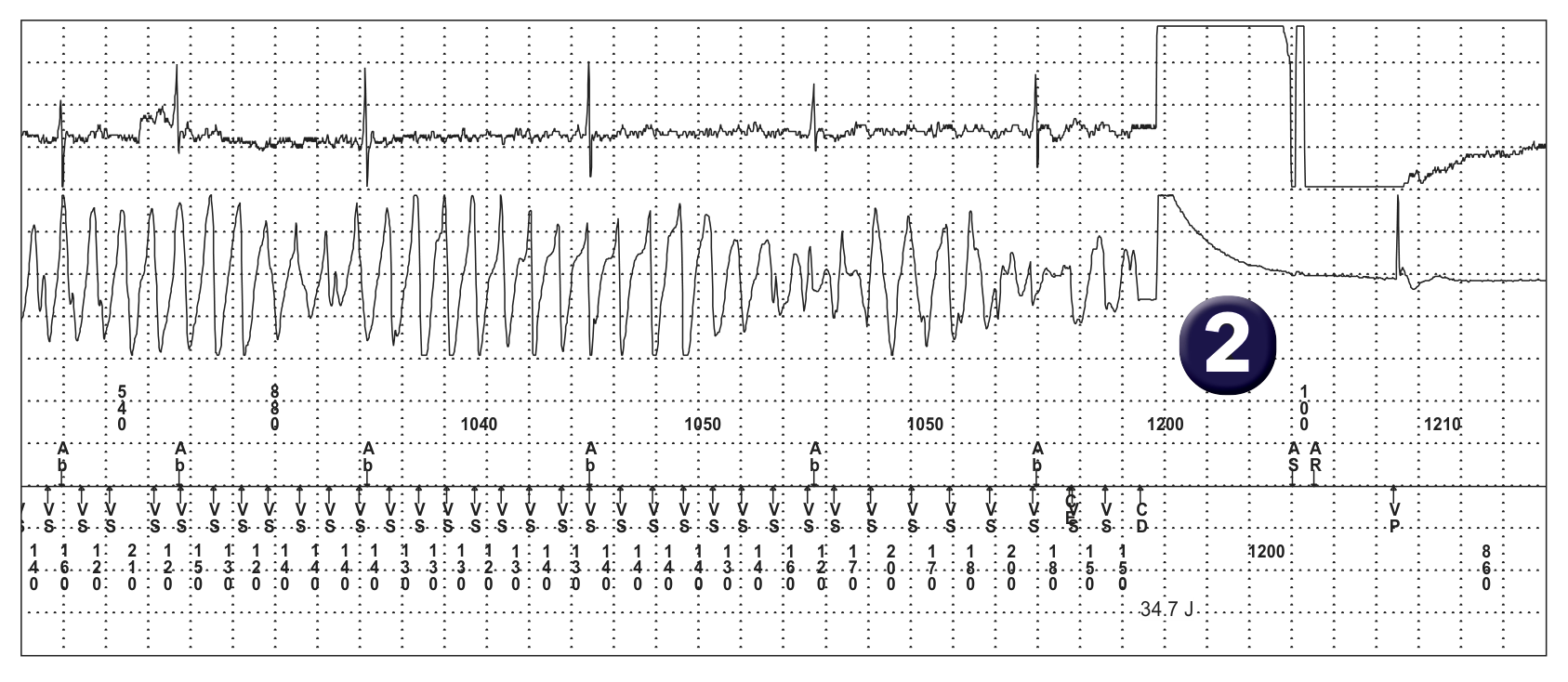 Medtronic ICD electrogram, segment 1 of 1 — Pro-arrhythmogenic effect of a low output shock