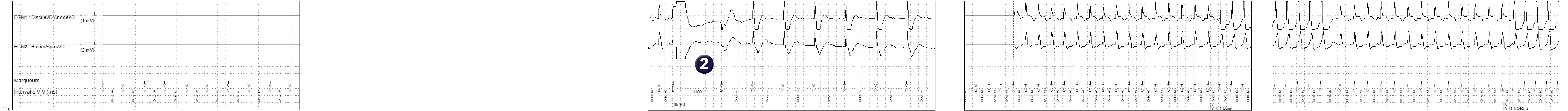 Medtronic ICD electrogram, segment 1 of 3 — Programming a first shock at maximum output in the VT zone
