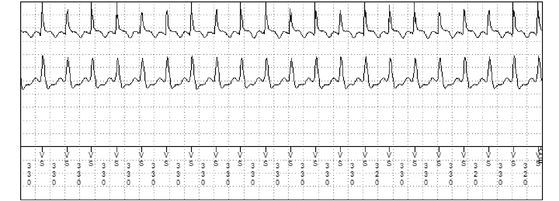 Medtronic ICD electrogram, segment 3 of 3 — Programming a first shock at maximum output in the VT zone