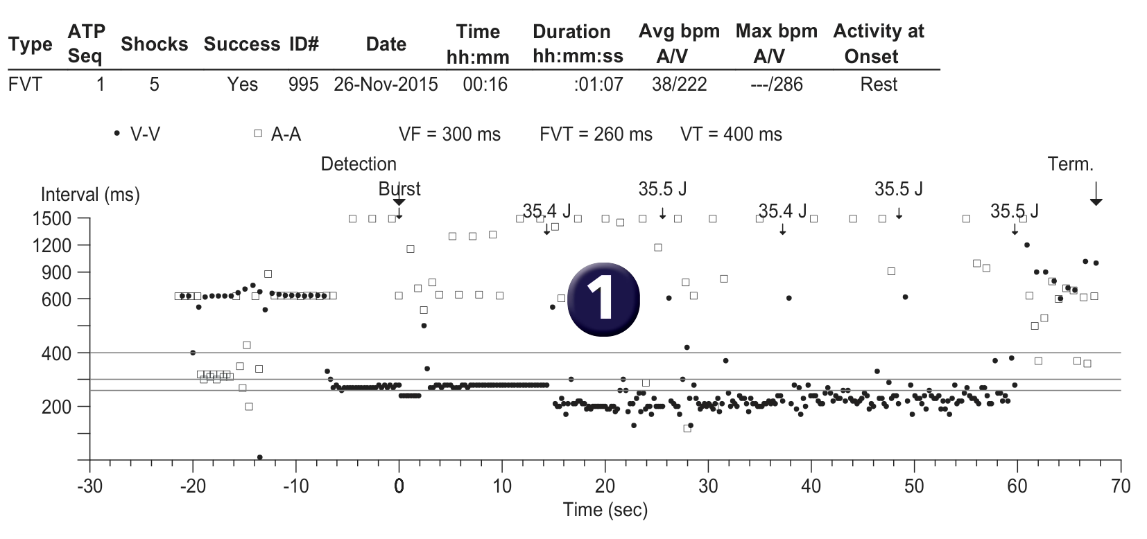 Medtronic ICD electrogram, segment 1 of 1 — Defibrillation threshold and upper limit of vulnerability