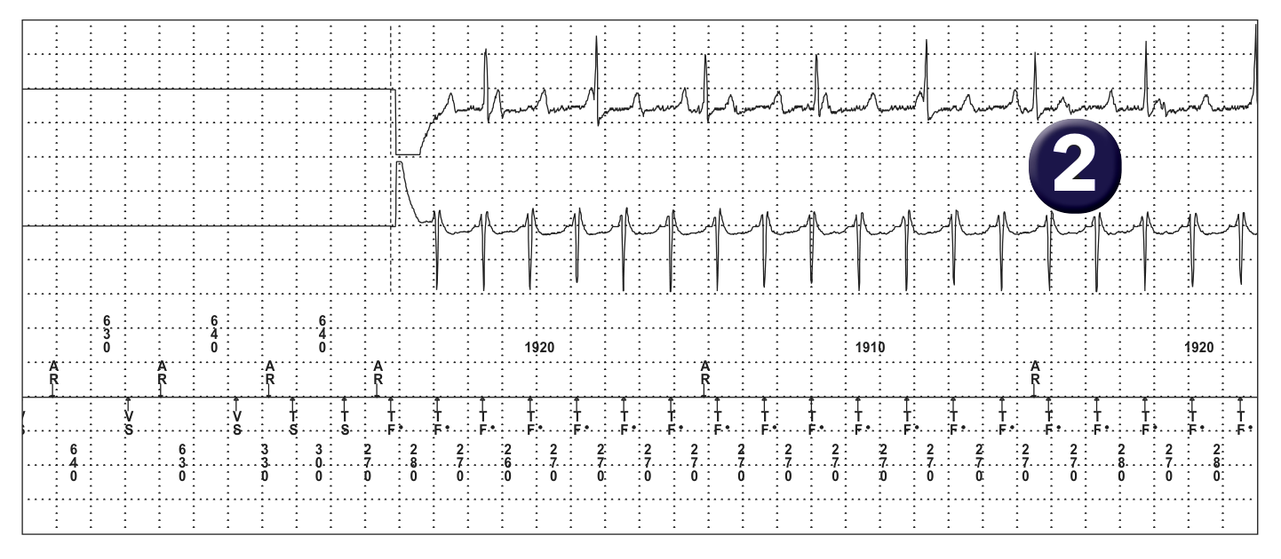 Medtronic ICD electrogram, segment 1 of 3 — Defibrillation threshold and upper limit of vulnerability