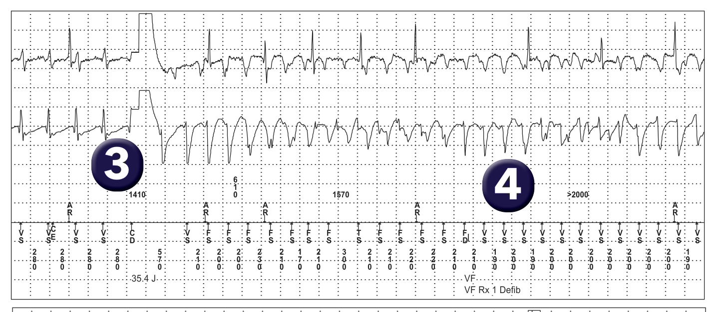 Medtronic ICD electrogram, segment 2 of 3 — Defibrillation threshold and upper limit of vulnerability