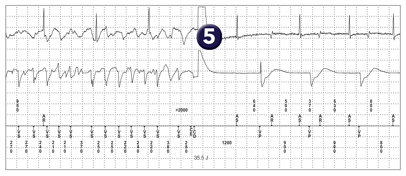Medtronic ICD electrogram, segment 3 of 3 — Defibrillation threshold and upper limit of vulnerability