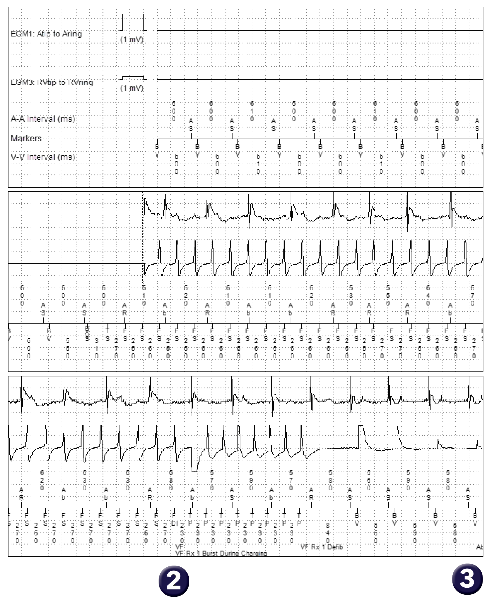 Medtronic ICD electrogram, segment 1 of 4 — Anti-tachycardia pacing in the VF zone