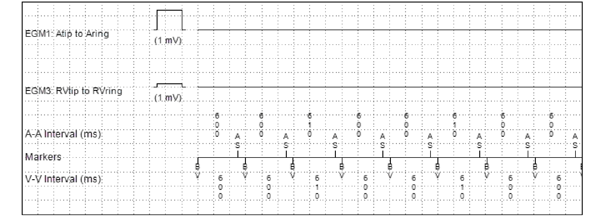 Medtronic ICD electrogram, segment 2 of 4 — Anti-tachycardia pacing in the VF zone