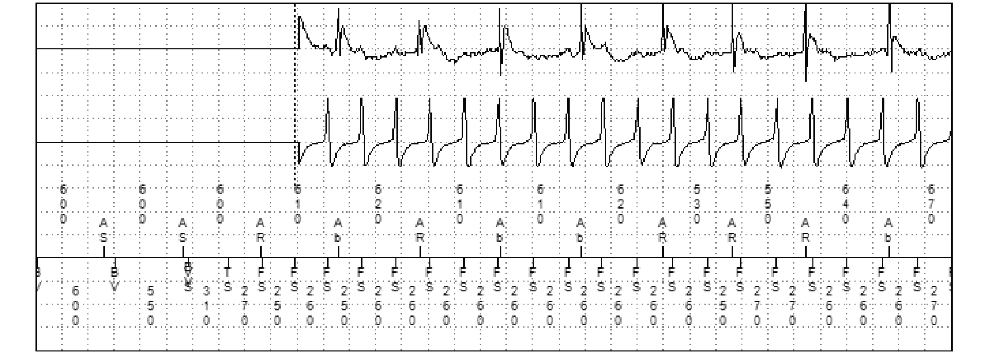 Medtronic ICD electrogram, segment 3 of 4 — Anti-tachycardia pacing in the VF zone