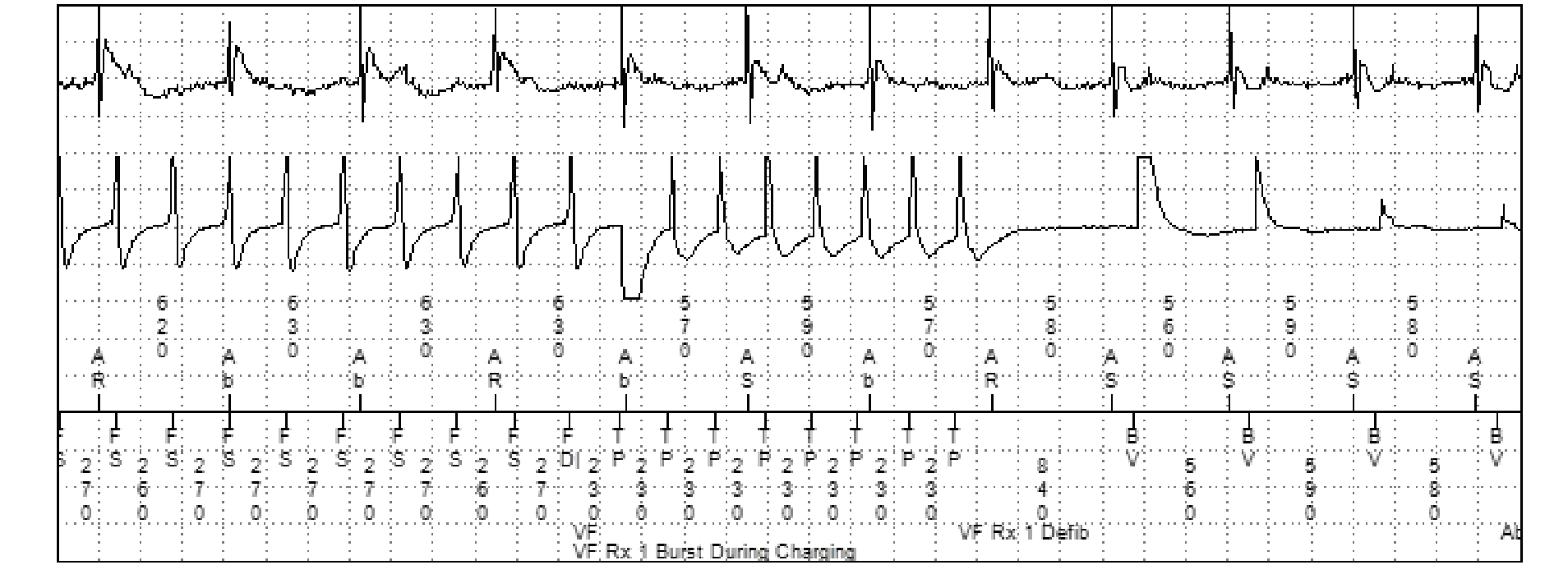 Medtronic ICD electrogram, segment 4 of 4 — Anti-tachycardia pacing in the VF zone