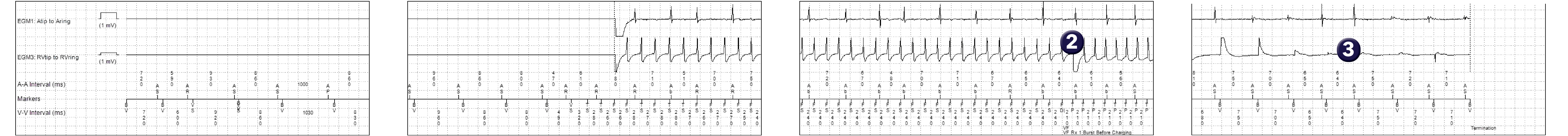 Medtronic ICD electrogram, segment 1 of 1 — Anti-tachycardia pacing in the VF zone and conserving energy