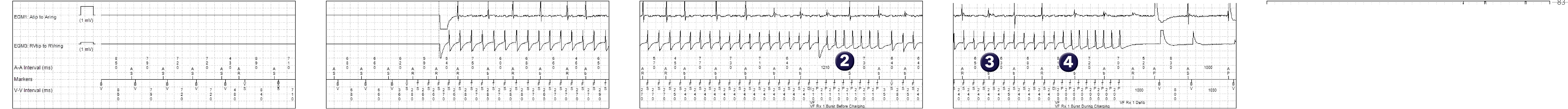 Medtronic ICD electrogram, segment 1 of 2 — Double anti-tachycardia pacing sequence