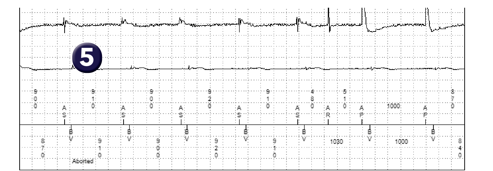 Medtronic ICD electrogram, segment 2 of 2 — Double anti-tachycardia pacing sequence