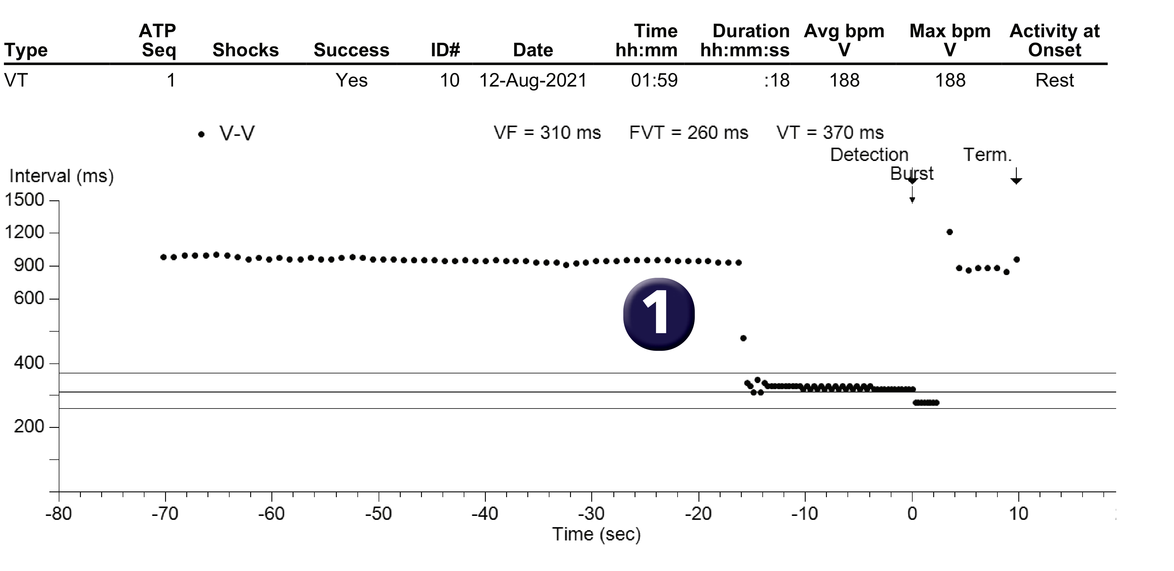 Medtronic ICD electrogram, segment 1 of 1 — Anti-tachycardia pacing in the VT zone