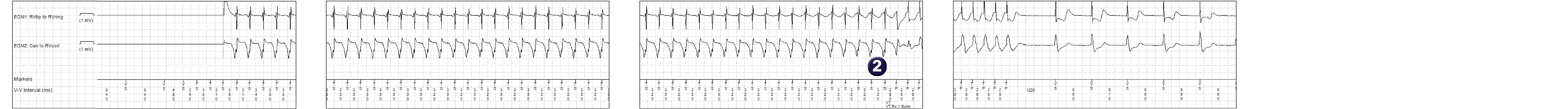 Medtronic ICD electrogram, segment 1 of 1 — Anti-tachycardia pacing in the VT zone
