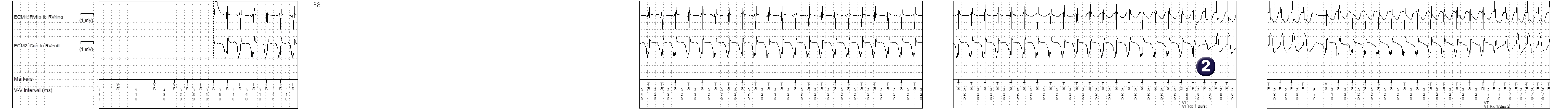 Medtronic ICD electrogram, segment 1 of 2 — Bursts or ramps ?