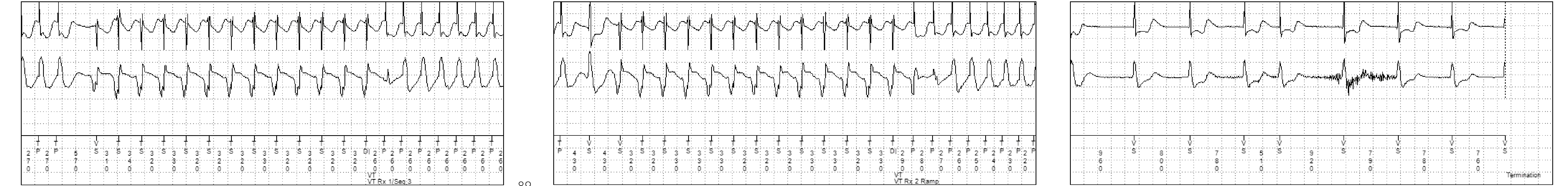 Medtronic ICD electrogram, segment 2 of 2 — Bursts or ramps ?