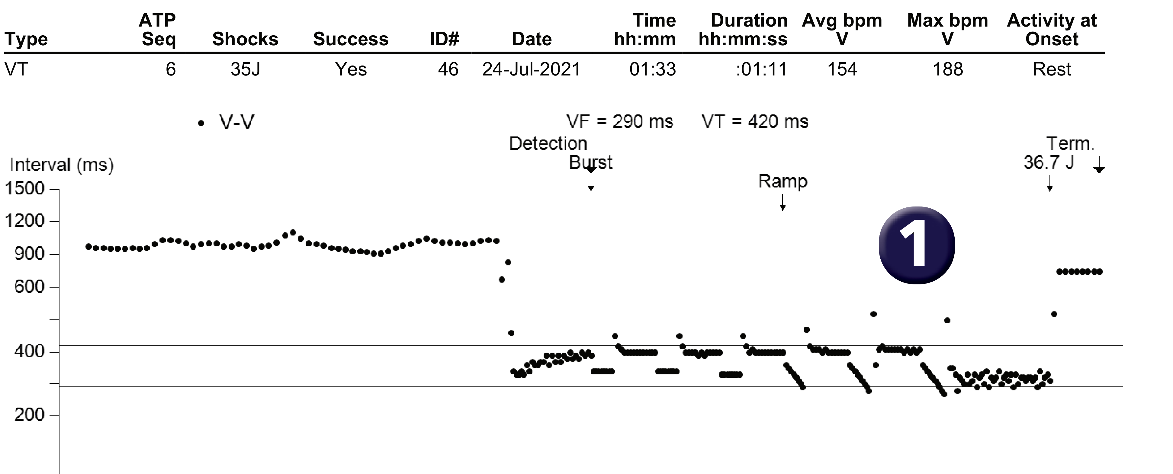 Medtronic ICD electrogram, segment 1 of 1 — Acceleration after several sequences of anti-tachycardia pacing