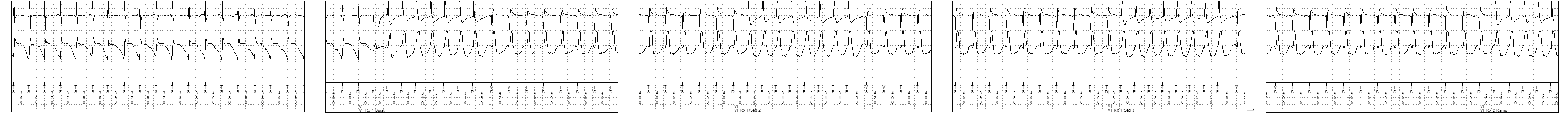 Medtronic ICD electrogram, segment 2 of 3 — Acceleration after several sequences of anti-tachycardia pacing