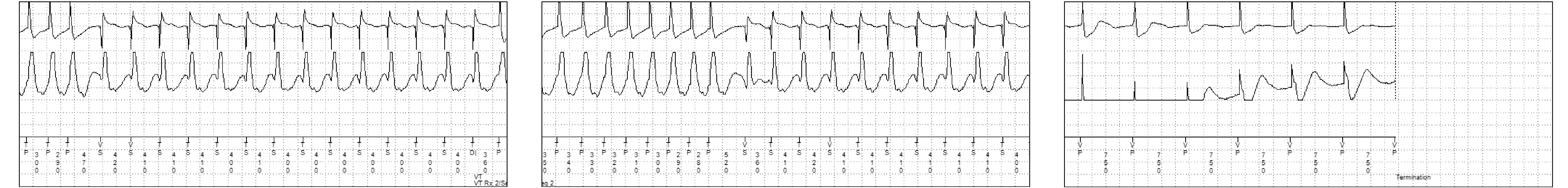 Medtronic ICD electrogram, segment 3 of 3 — Acceleration after several sequences of anti-tachycardia pacing