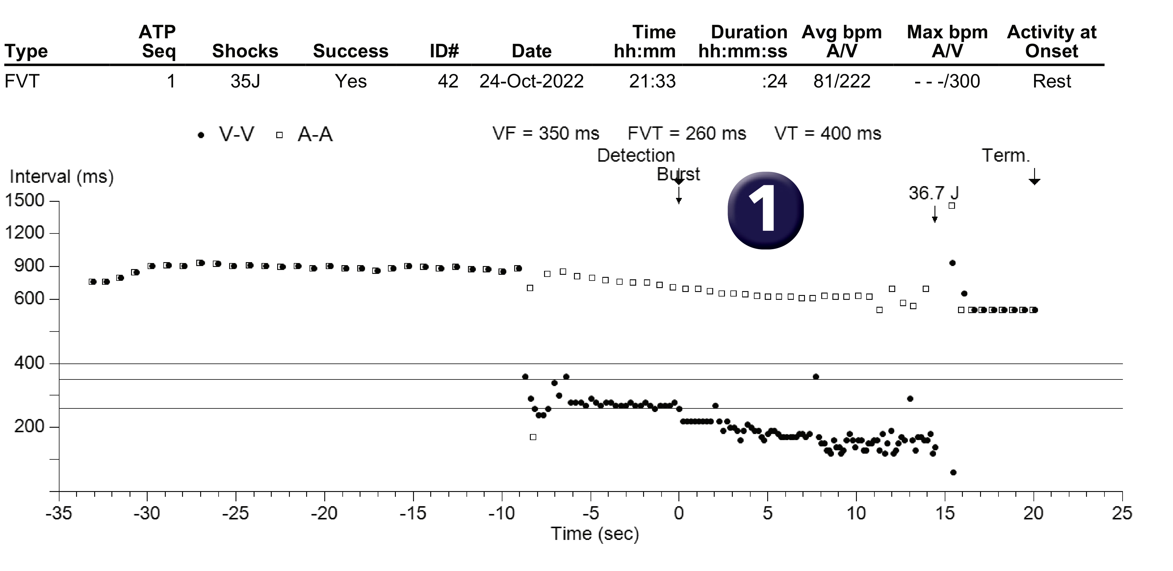 Medtronic ICD electrogram, segment 1 of 1 — Accceleration after anti-tachycardia pacing