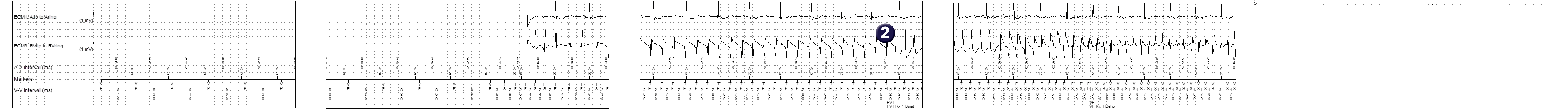 Medtronic ICD electrogram, segment 1 of 2 — Accceleration after anti-tachycardia pacing