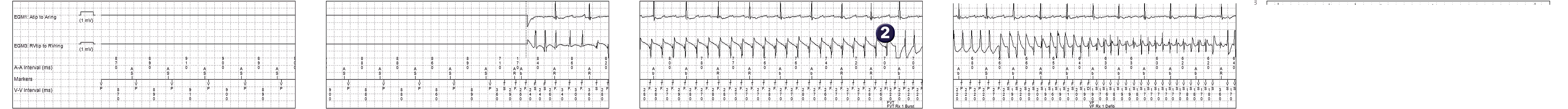 Medtronic ICD electrogram, segment 1 of 2 — Acceleration after anti-tachycardia pacing