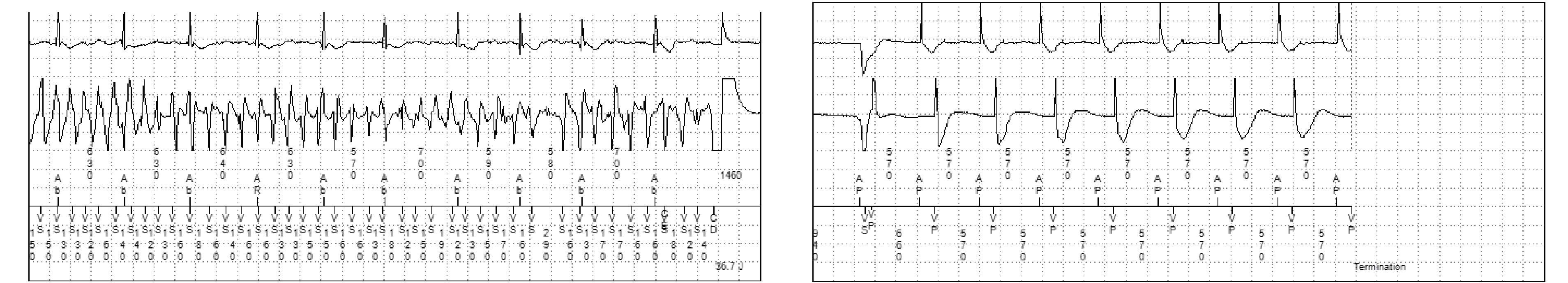 Medtronic ICD electrogram, segment 2 of 2 — Accceleration after anti-tachycardia pacing