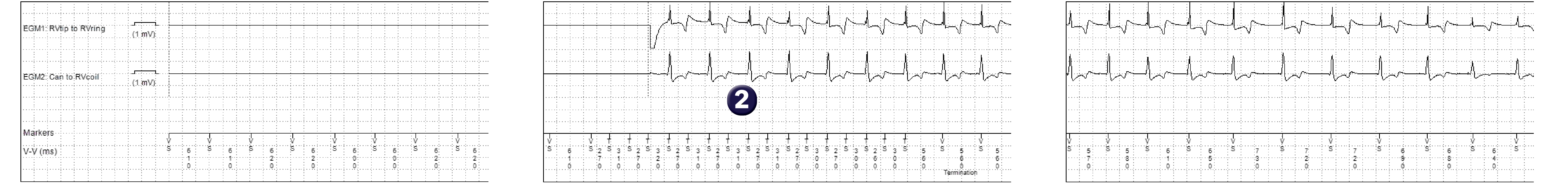 Medtronic ICD electrogram, segment 1 of 1 — A special kind of plot