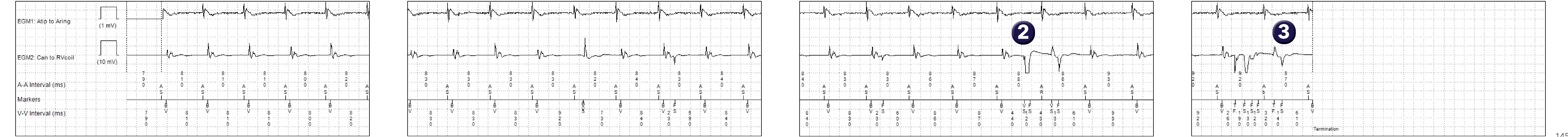 Medtronic ICD electrogram, segment 1 of 1 — Ventricular cycles too short to be physiological