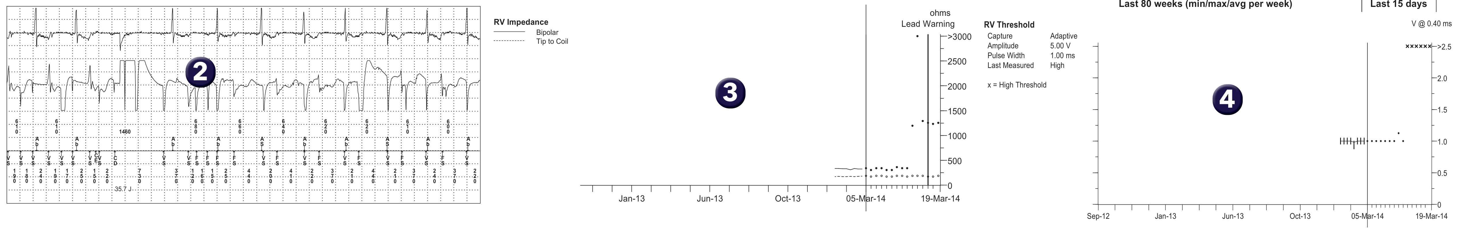 Medtronic ICD electrogram, segment 1 of 1 — Telemedicine monitoring to avoid disasters
